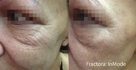 Under-eye skin remodelling with Fractora