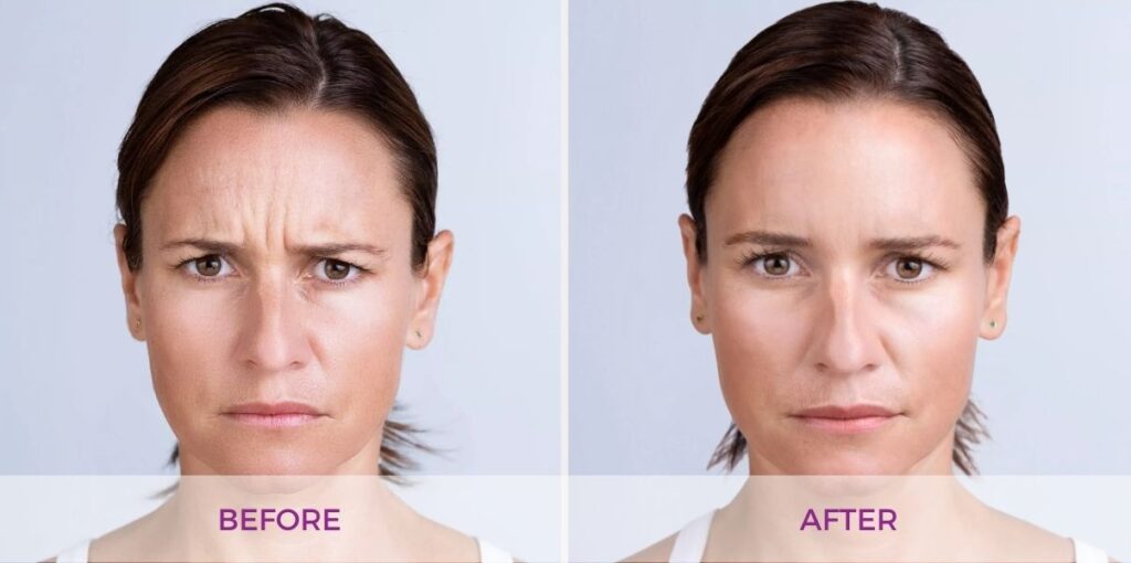 Xeomin before and after