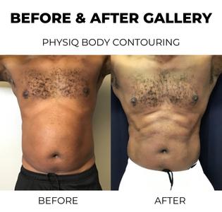 Before and after Physiq body contouring