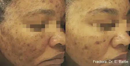 Reduction in blemishes and scars with Fractora