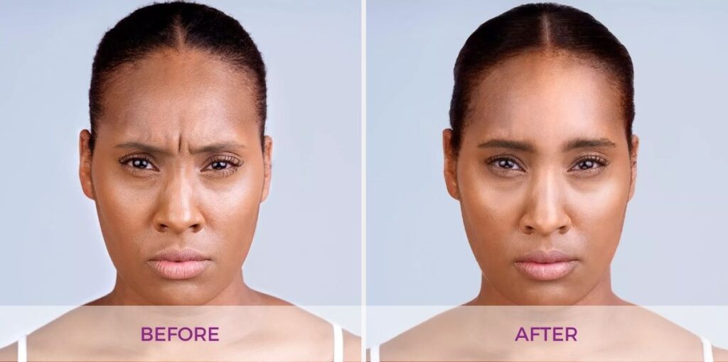 Xeomin injections before and after