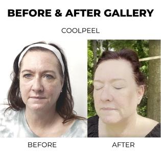 Before and after Coolpeel