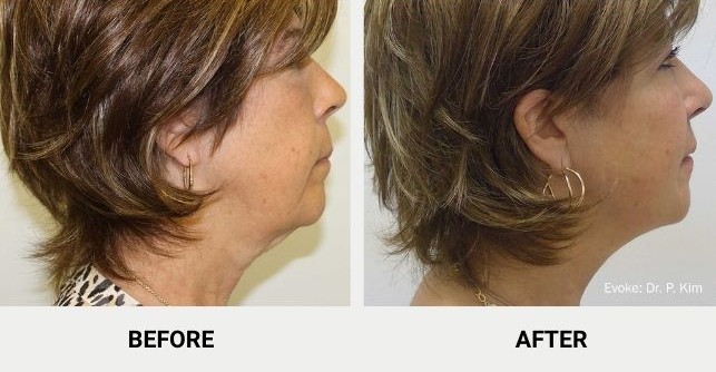 Mini neck lift with Evoke