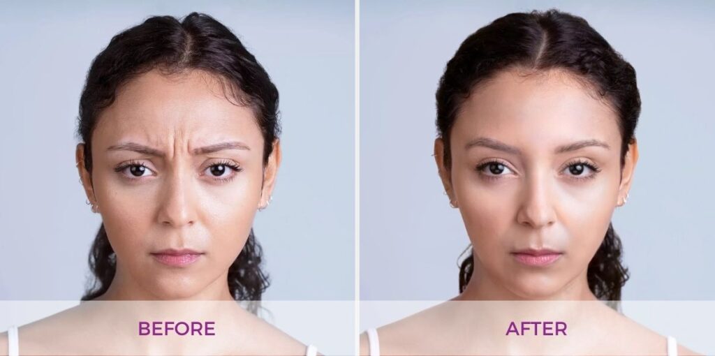 Xeomin before and after forehead