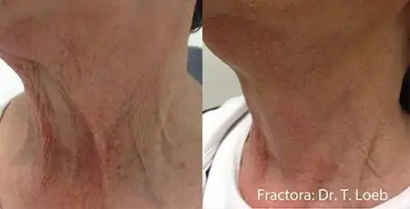Fractora neck rejuvenation
