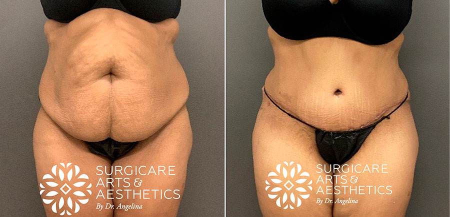 Abdominoplasty with liposuction 6 weeks post op