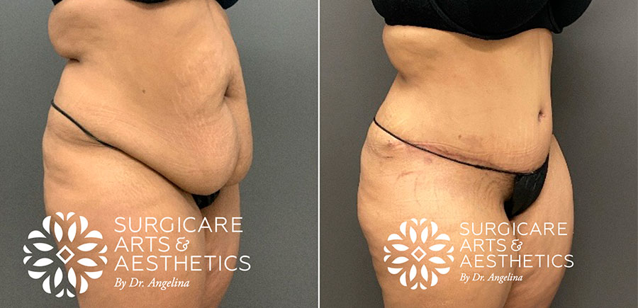 Tummy tuck before & after