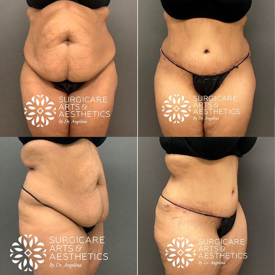 Tummy tuck scars