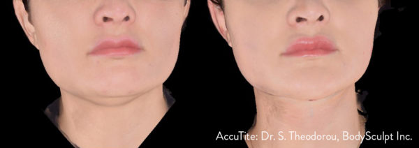 AccuTite-AFTER