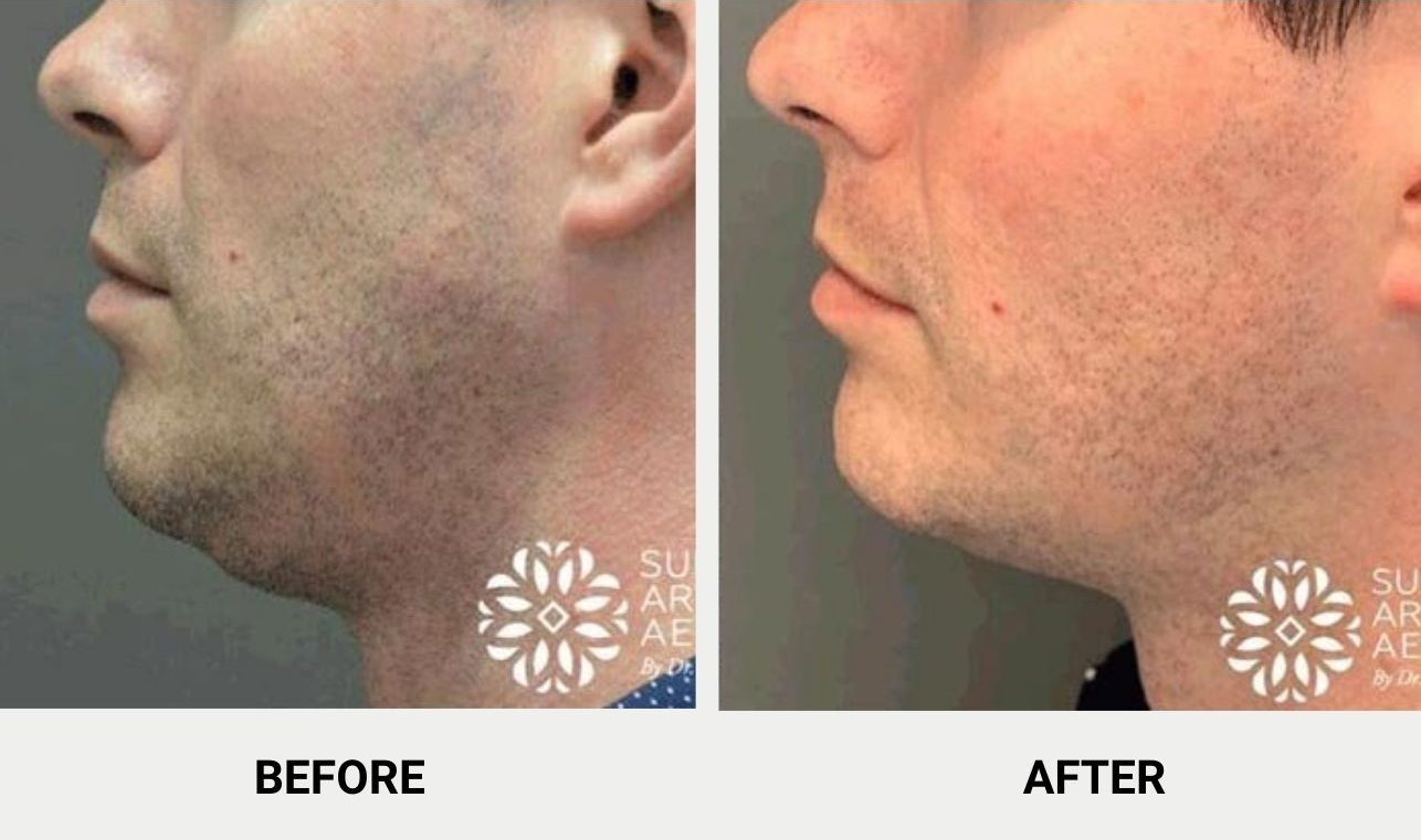 Double chin reduction with Morpheus8