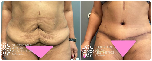 Abdominoplasty Before And After