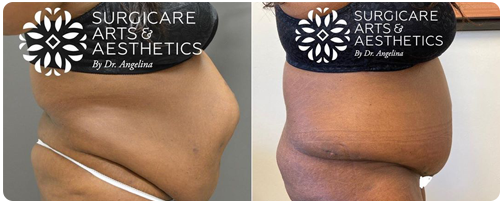 Tummy tuck with muscle repair before and after