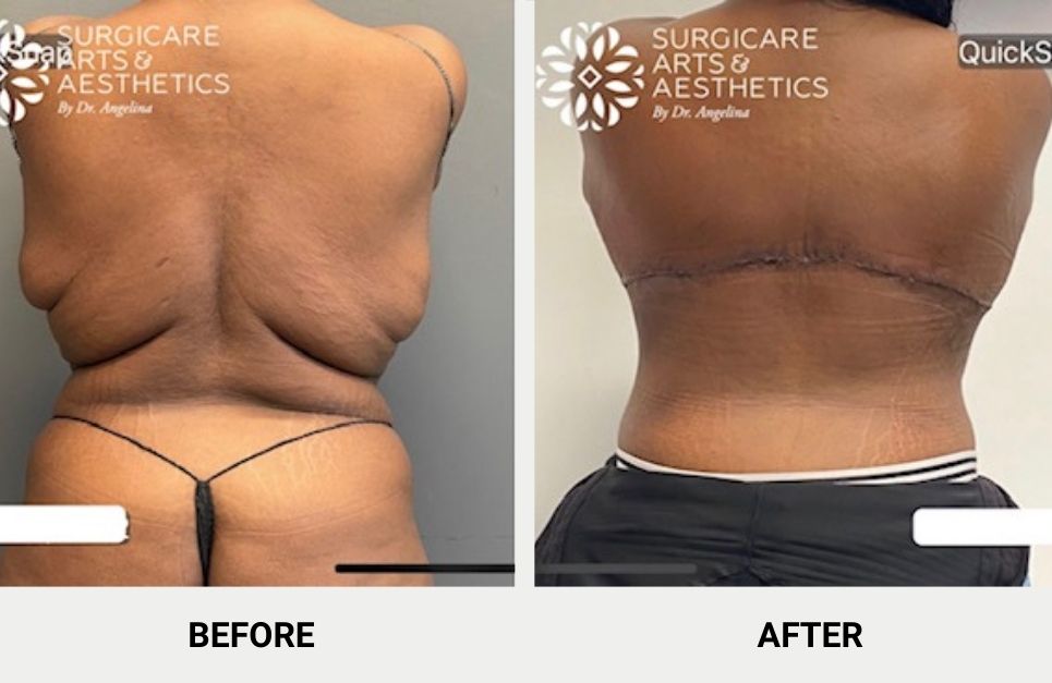 Bra Line Back Lift Before and After in Chicago IL