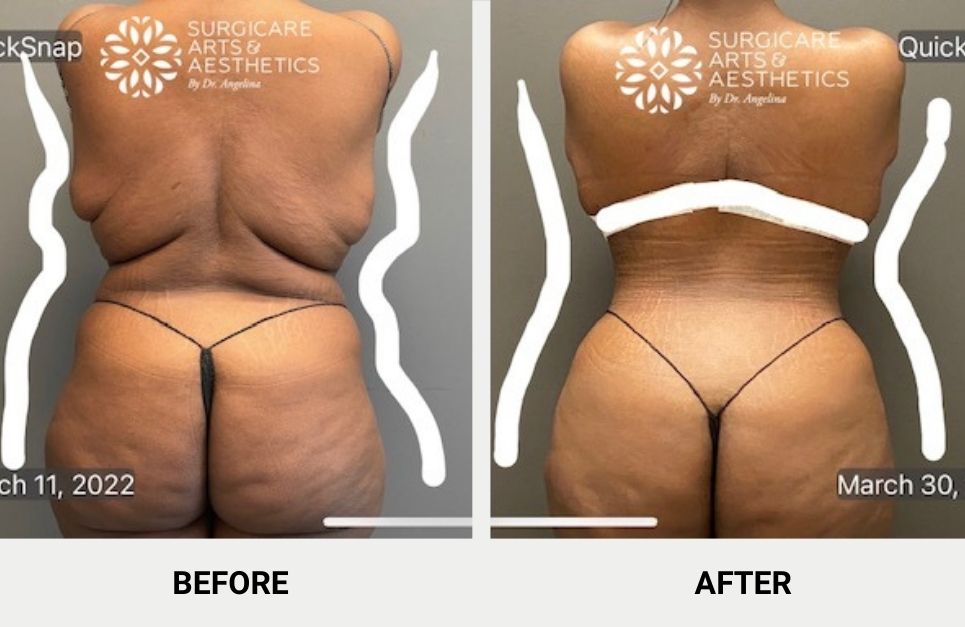 Bra Line Back Lift Signature Procedures Pictures