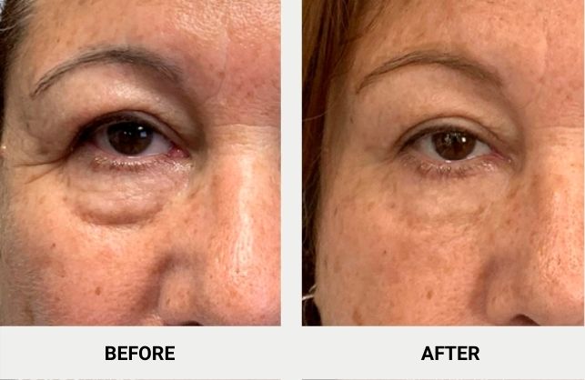 Accutite Before & After
