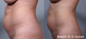 BodyFX - Before And After Photos 