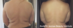 BodyFX Before And After 