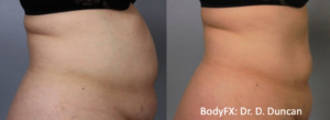 BodyFX Before And After Photos 