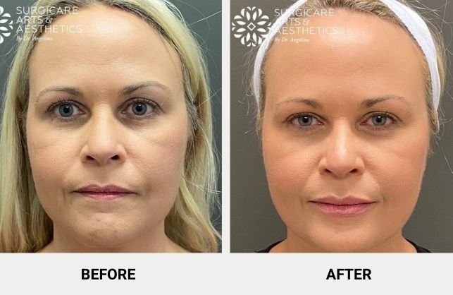 Botox before and after results