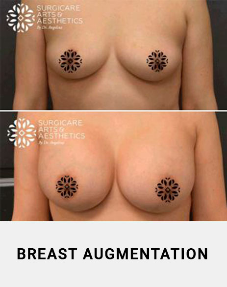 Breast Augmentation Atlanta