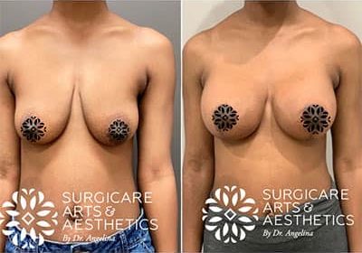 photos before and after breast lift with breast implants