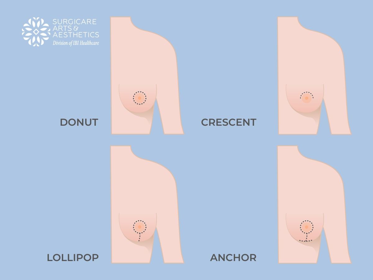 Breast surgery incisions