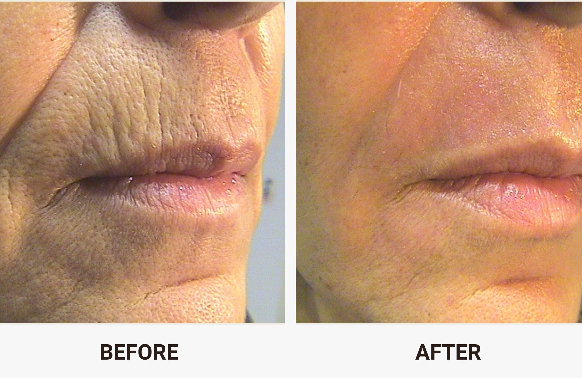 CoolPeel before and after