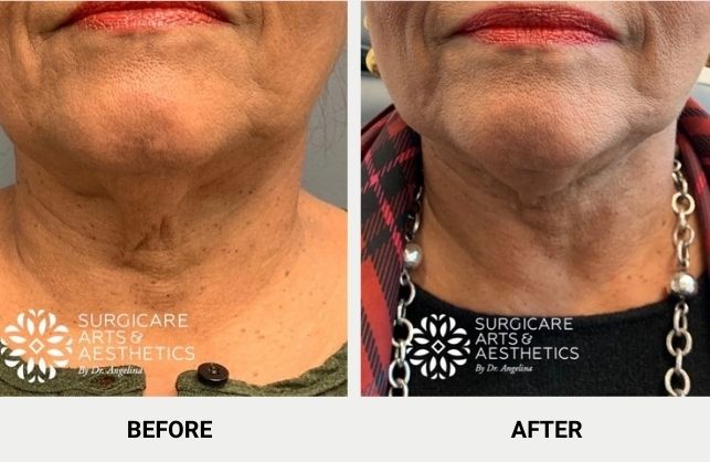 FaceTite for mini neck lift