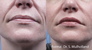 Non-Invasive Facial Contouring Forma: Before And After Photos