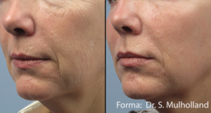 Non-Invasive Facial Contouring Forma Before And After Photo