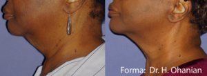 Non-Invasive Facial Contouring Forma: Before And After Photos Atlanta