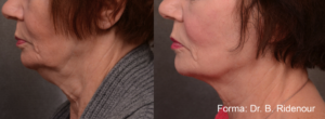 Non-Invasive Facial Contouring Forma: Before And After Photos in Atlanta