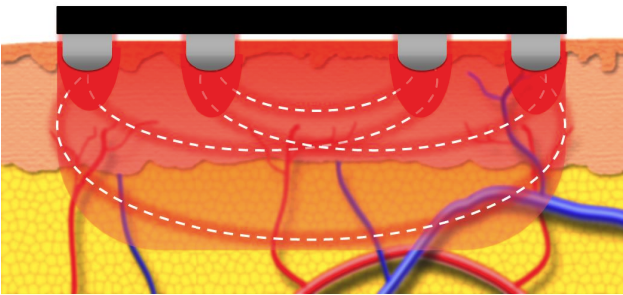 Forma: Safe and Effective Non-Invasive Facial Contouring