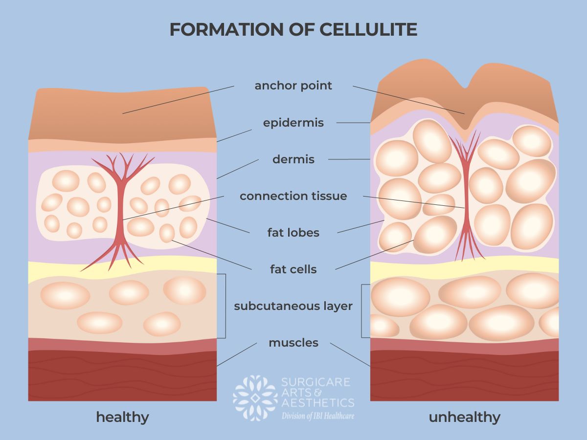 Formation of cellulite