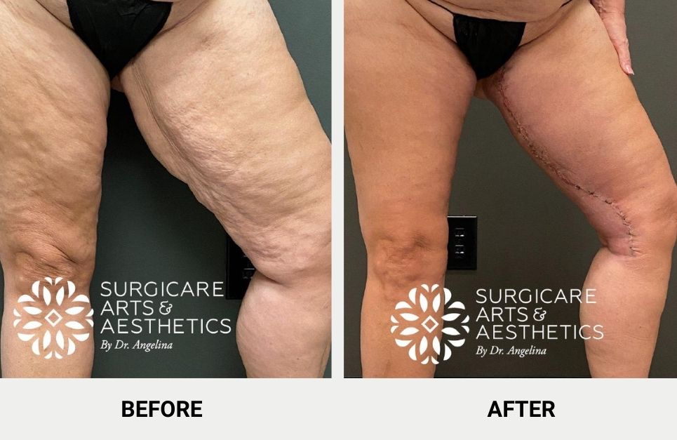 Thigh Lift Scars After 1 Year: Things to Expect - Salameh Plastic