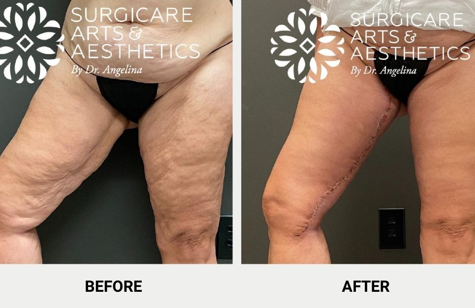 Thigh Lift Scars: Where Are Incisions For Different Thigh Lifts Made?