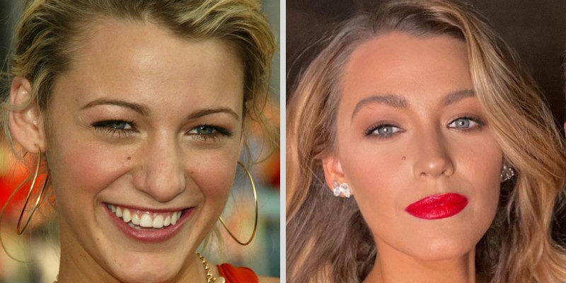 Blake Lively celebrity upper blepharoplasty before and after pictures