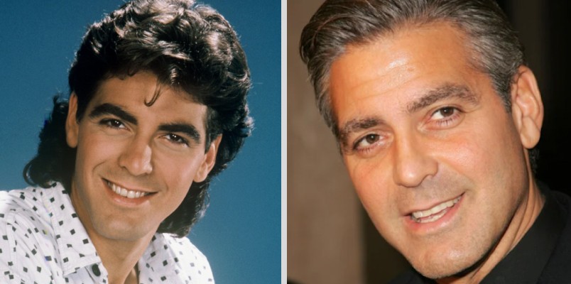 George Clooney blepharoplasty