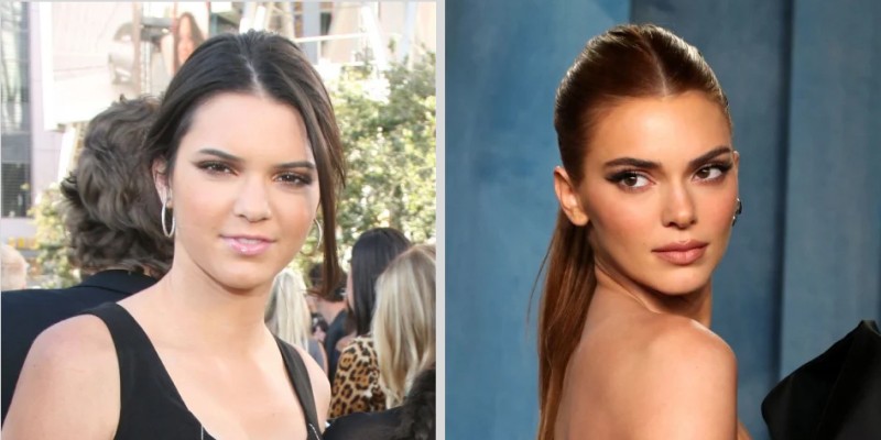 Kendall Jenner blepharoplasty