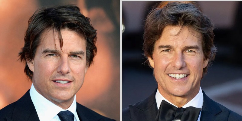 Tom Cruise upper blepharoplasty