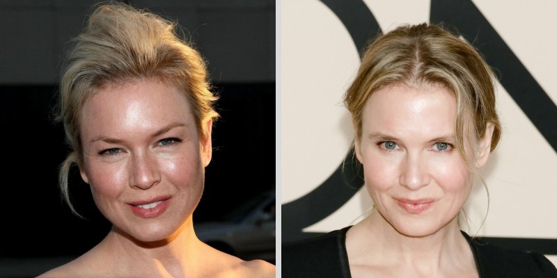 Renee Zellweger eyelid surgery celebrity blepharoplasty before and after
