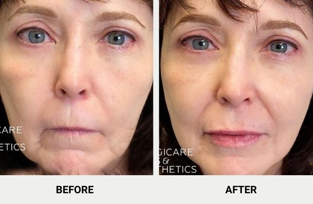 Juvederm® Vollure before and after