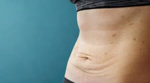 Best Ways to Tighten Loose Skin After Pregnancy