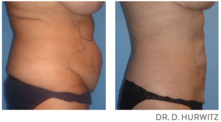 Minimally Invasive Body Contouring before after