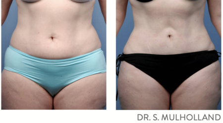 Minimally Invasive Body Contouring before and after