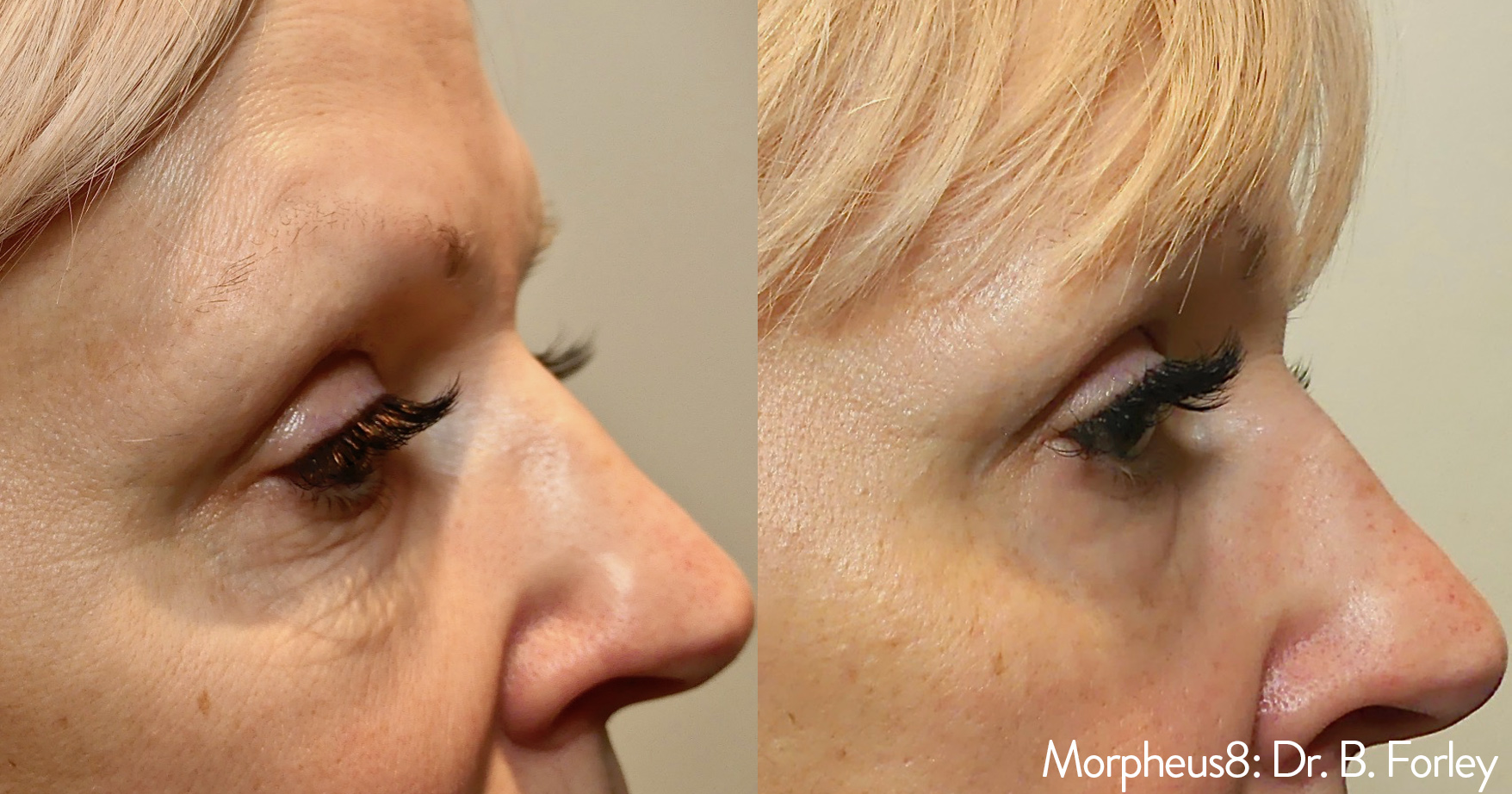 Morpheus8 under eyes before and after