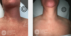 Morpheus8: Fractional Treatment for Skin in Atlanta, GA