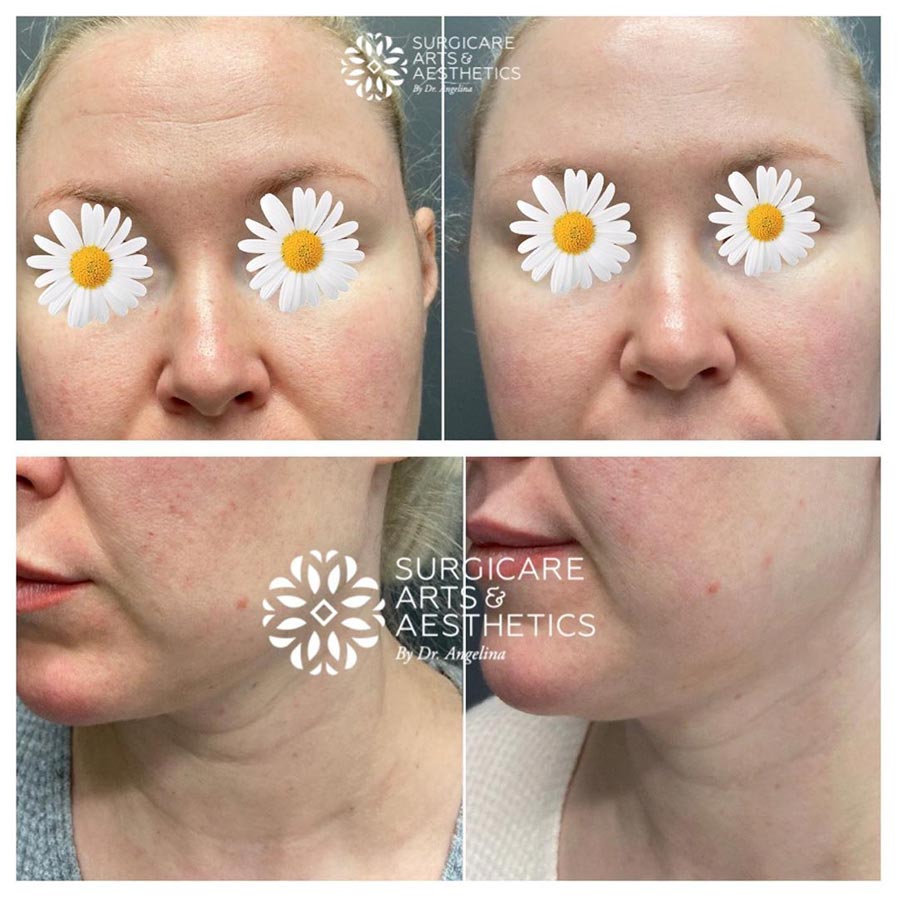 Microneedling before and after 1 treatment