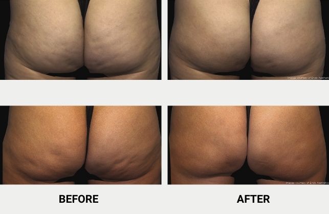 QWO cellulite treatment before and after