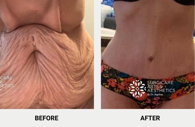 Removing excess skin with tummy tuck before and after photos
